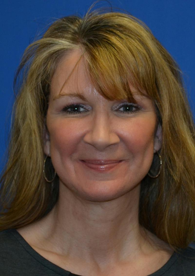 Facelift Before & After Gallery - Patient 226160 - Image 10