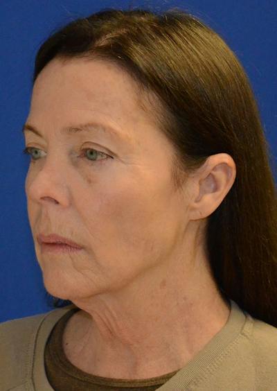 Facelift Before & After Gallery - Patient 397714 - Image 1