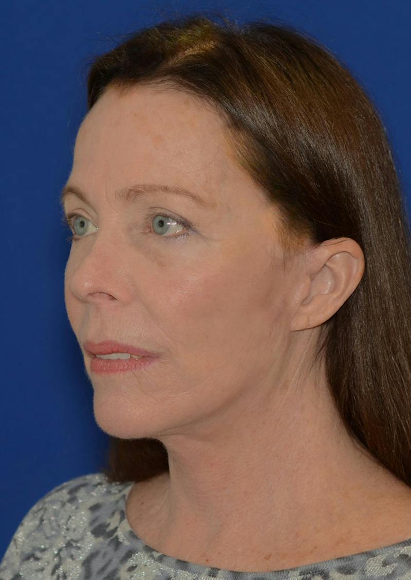 Facelift Before & After Gallery - Patient 397714 - Image 2