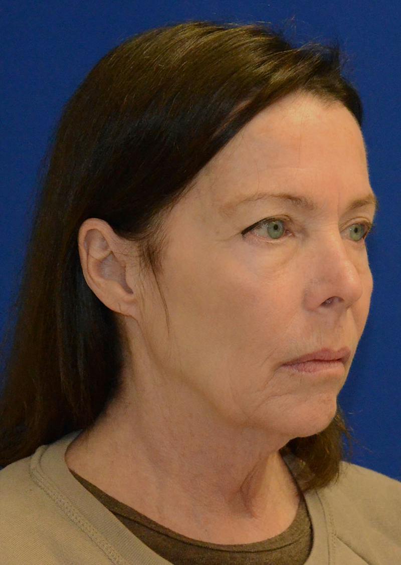 Facelift Before & After Gallery - Patient 397714 - Image 3