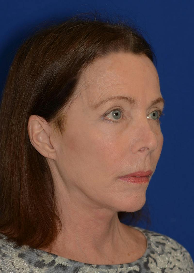 Facelift Before & After Gallery - Patient 397714 - Image 4