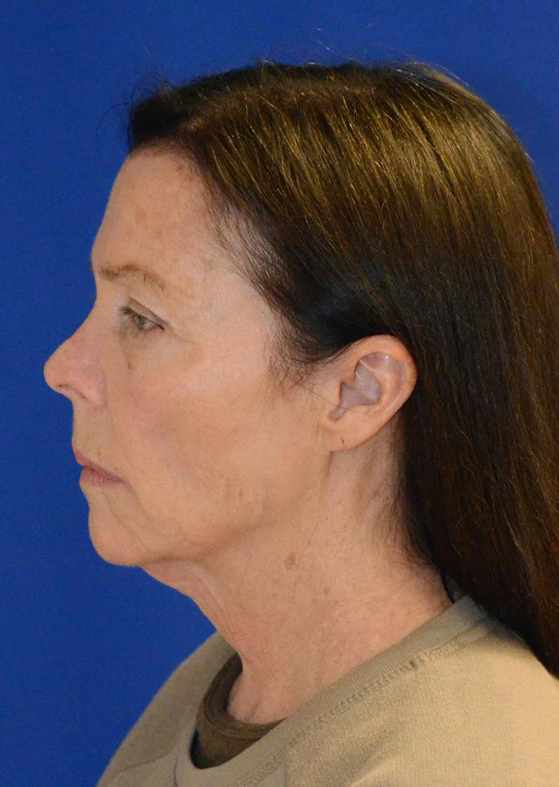 Facelift Before & After Gallery - Patient 397714 - Image 5