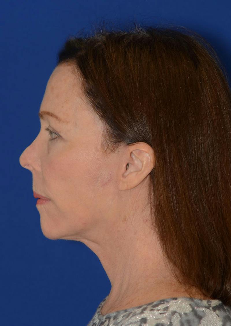 Facelift Before & After Gallery - Patient 397714 - Image 6