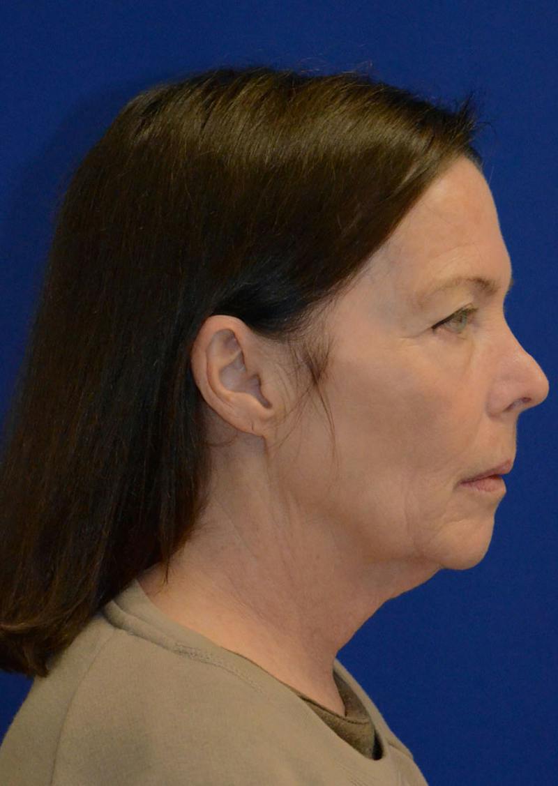Facelift Before & After Gallery - Patient 397714 - Image 7
