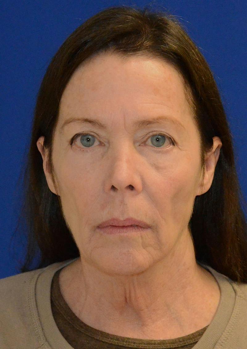 Facelift Before & After Gallery - Patient 397714 - Image 9