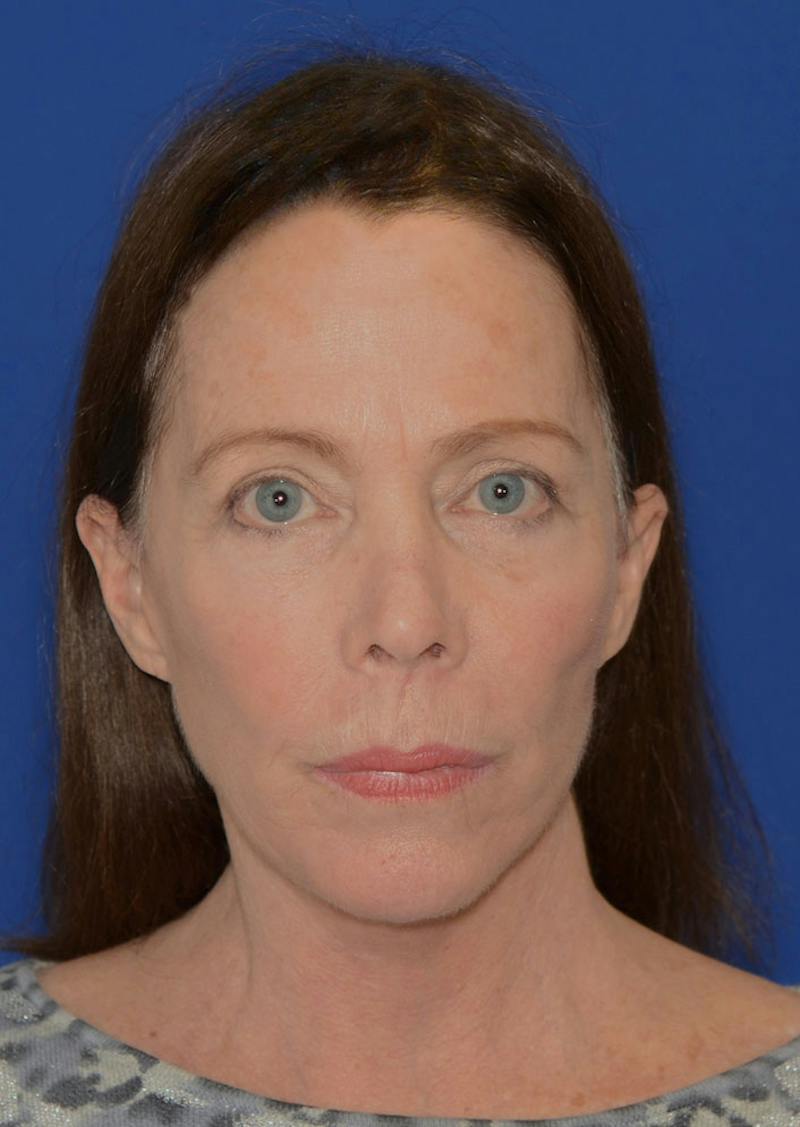 Facelift Before & After Gallery - Patient 397714 - Image 10