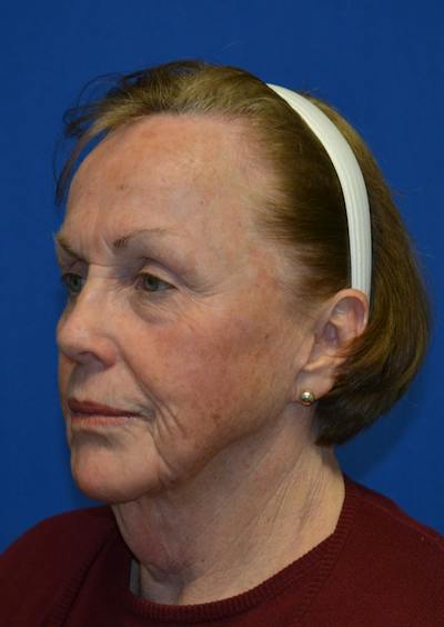 Facelift Before & After Gallery - Patient 399032 - Image 1