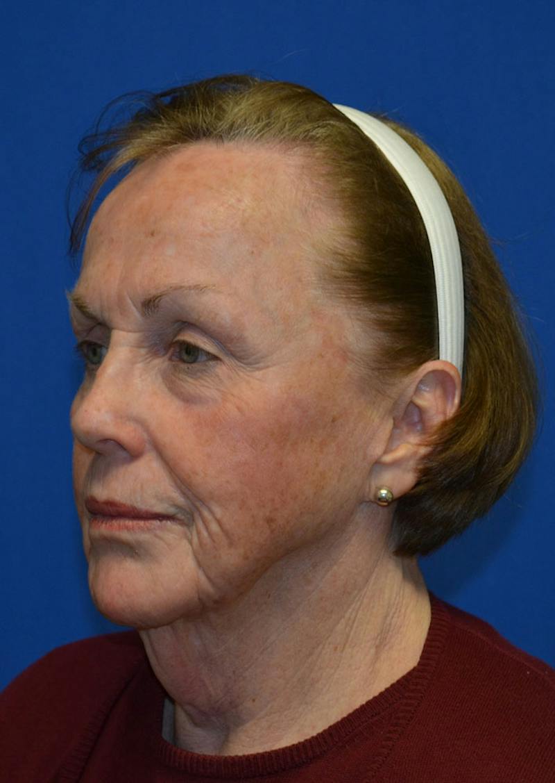 Facelift Before & After Gallery - Patient 399032 - Image 1