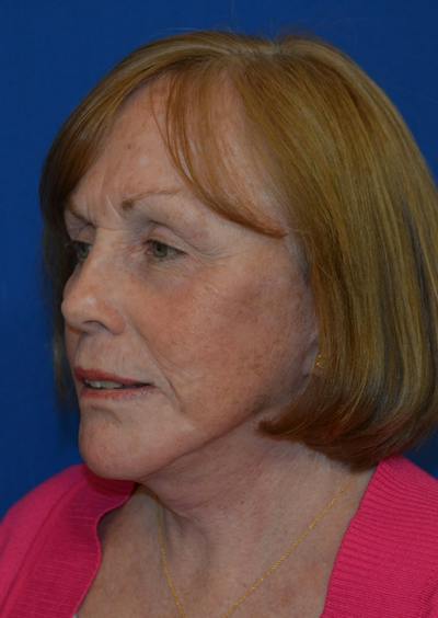 Facelift Before & After Gallery - Patient 399032 - Image 2