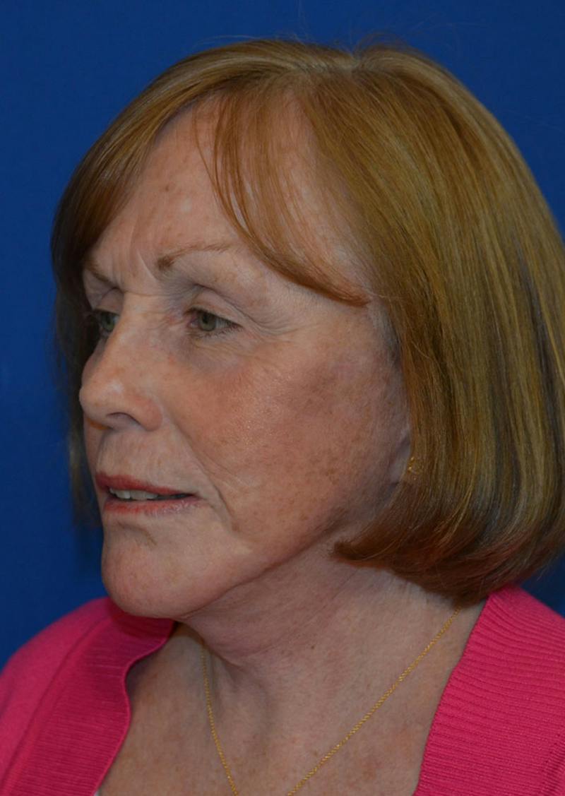 Facelift Before & After Gallery - Patient 399032 - Image 2