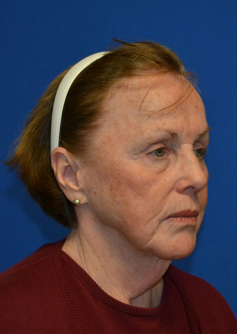 Facelift Before & After Gallery - Patient 399032 - Image 3