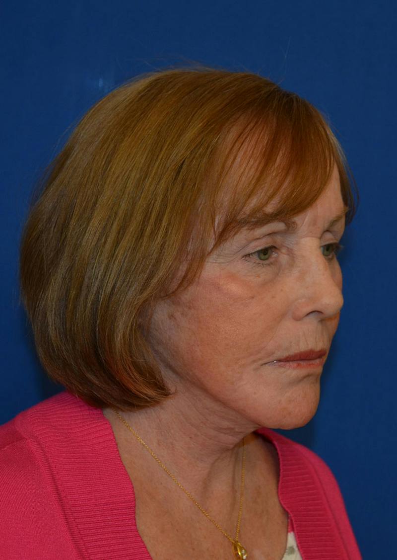 Facelift Before & After Gallery - Patient 399032 - Image 4