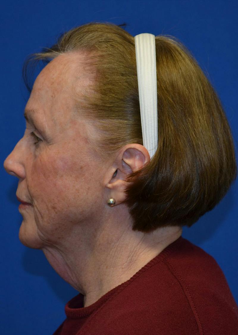 Facelift Before & After Gallery - Patient 399032 - Image 5