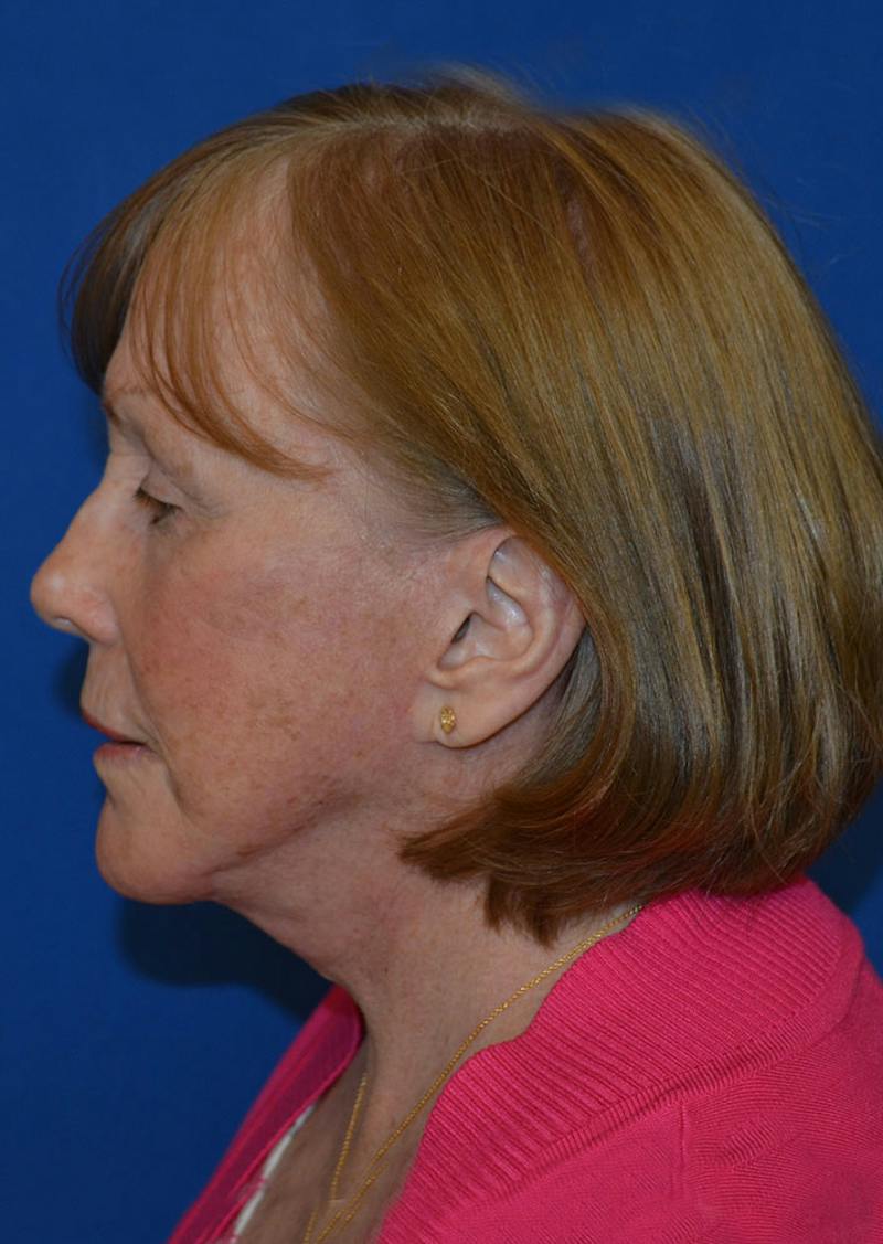 Facelift Before & After Gallery - Patient 399032 - Image 6