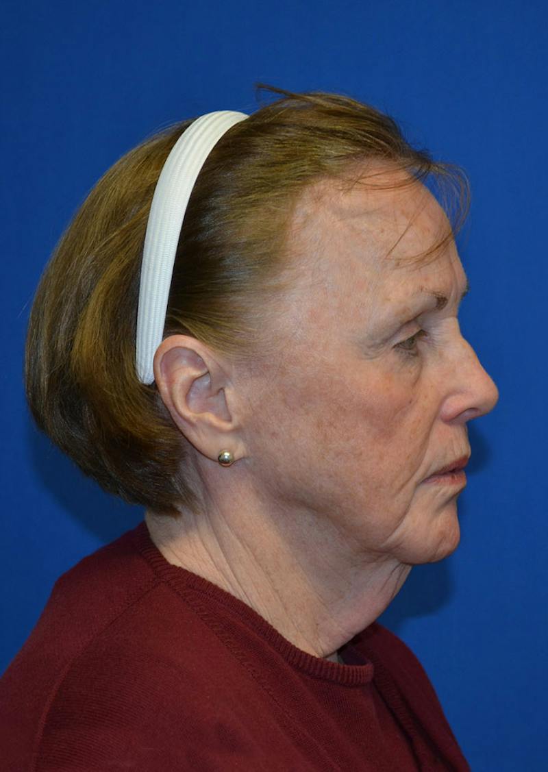 Facelift Before & After Gallery - Patient 399032 - Image 7