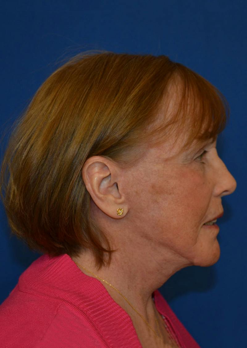 Facelift Before & After Gallery - Patient 399032 - Image 8