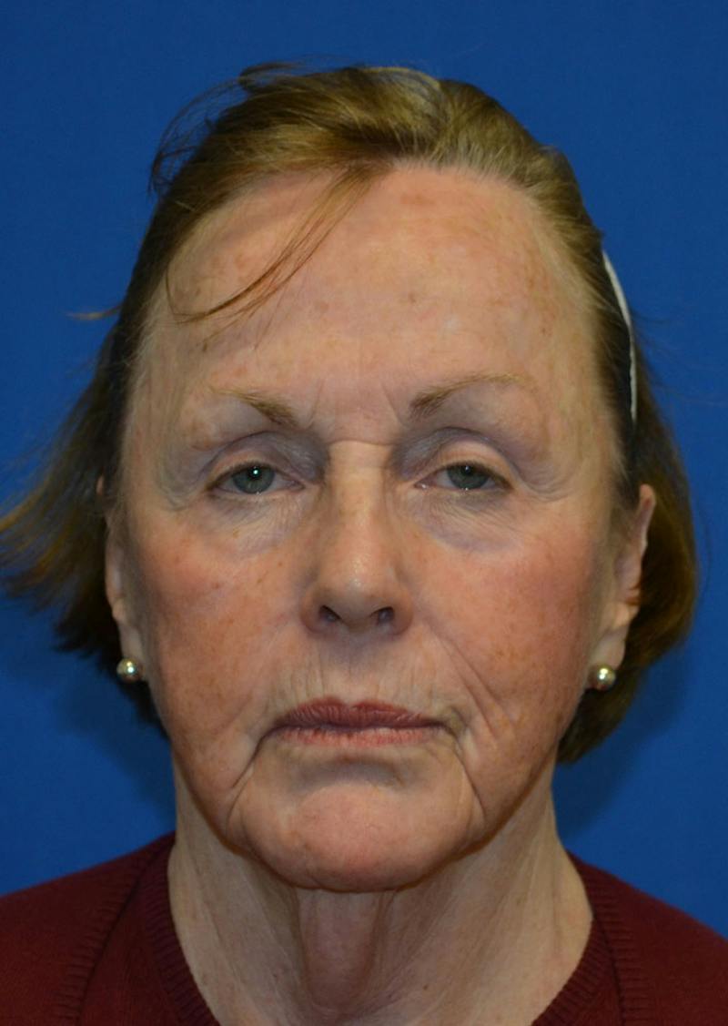 Facelift Before & After Gallery - Patient 399032 - Image 9