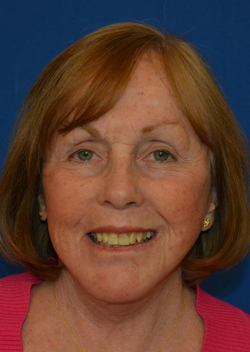 Facelift Before & After Gallery - Patient 399032 - Image 10
