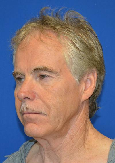 Facelift Before & After Gallery - Patient 380118 - Image 1