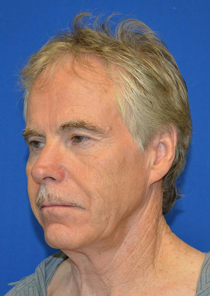 Facelift Before & After Gallery - Patient 380118 - Image 1
