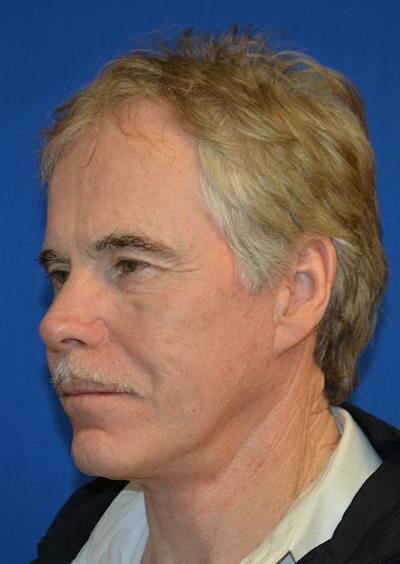 Facelift Before & After Gallery - Patient 380118 - Image 2