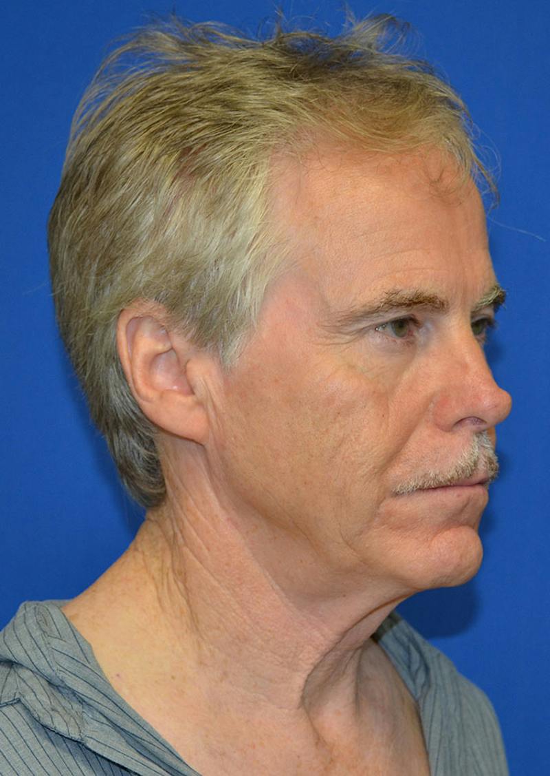 Facelift Before & After Gallery - Patient 380118 - Image 3