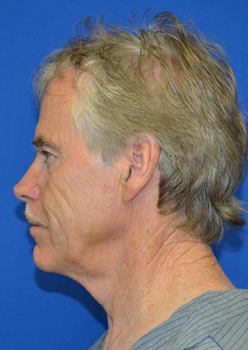 Facelift Before & After Gallery - Patient 380118 - Image 5