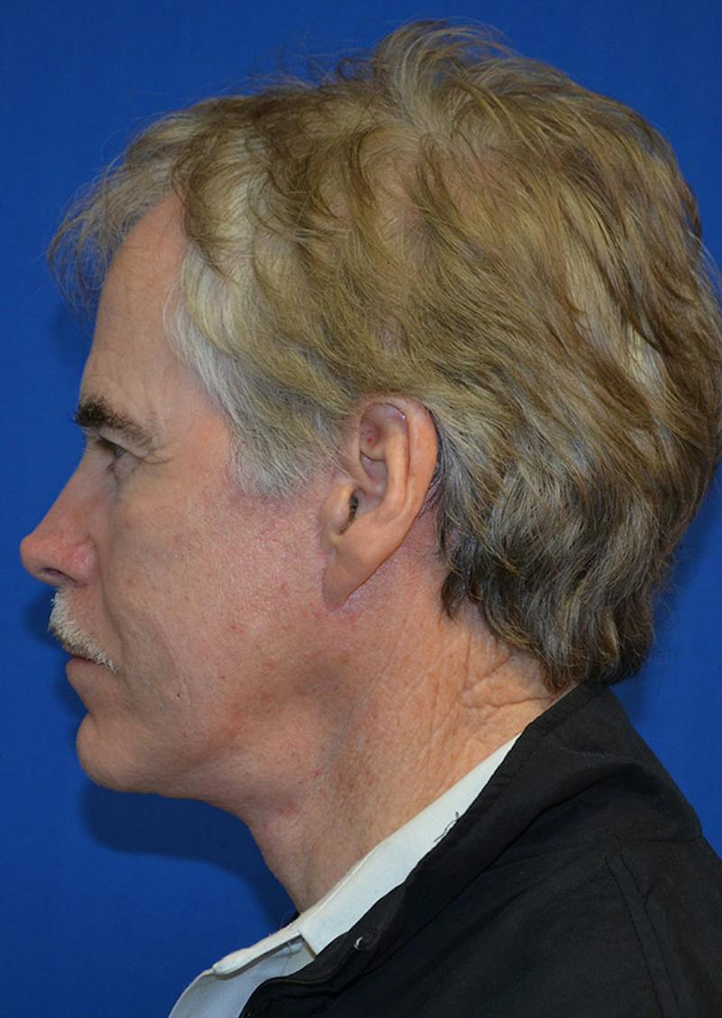 Facelift Before & After Gallery - Patient 380118 - Image 6
