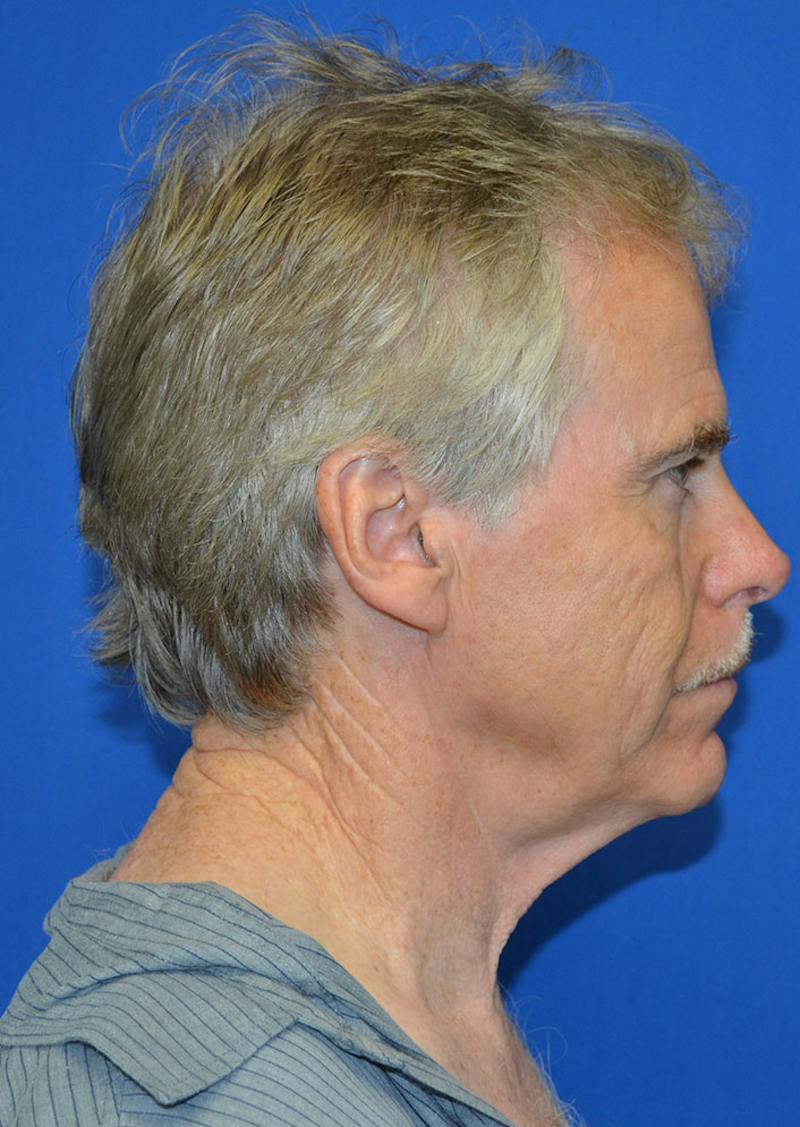 Facelift Before & After Gallery - Patient 380118 - Image 7