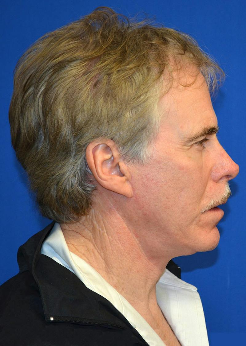 Facelift Before & After Gallery - Patient 380118 - Image 8