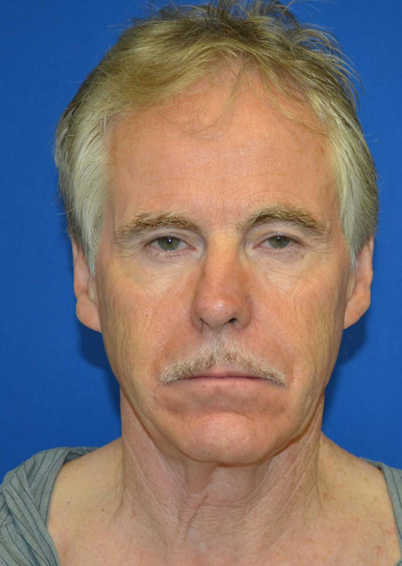 Facelift Before & After Gallery - Patient 380118 - Image 9
