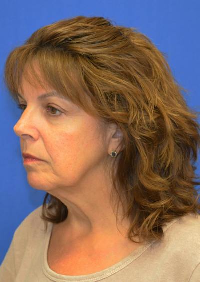 Facelift Before & After Gallery - Patient 149267 - Image 1