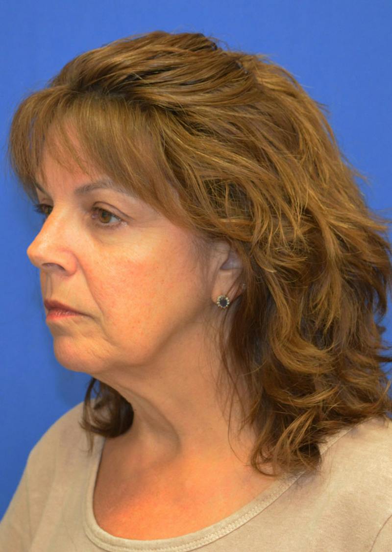 Facelift Before & After Gallery - Patient 149267 - Image 1