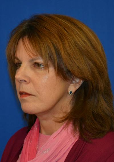Facelift Before & After Gallery - Patient 149267 - Image 2