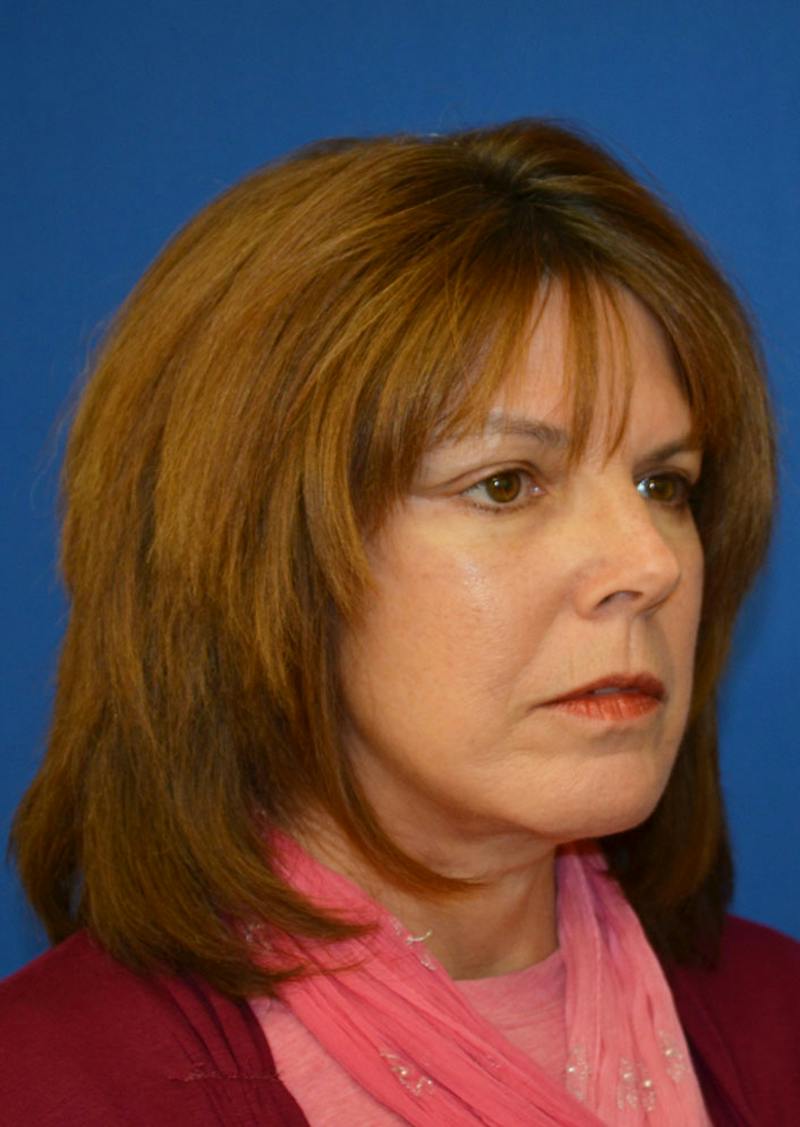 Facelift Before & After Gallery - Patient 149267 - Image 4