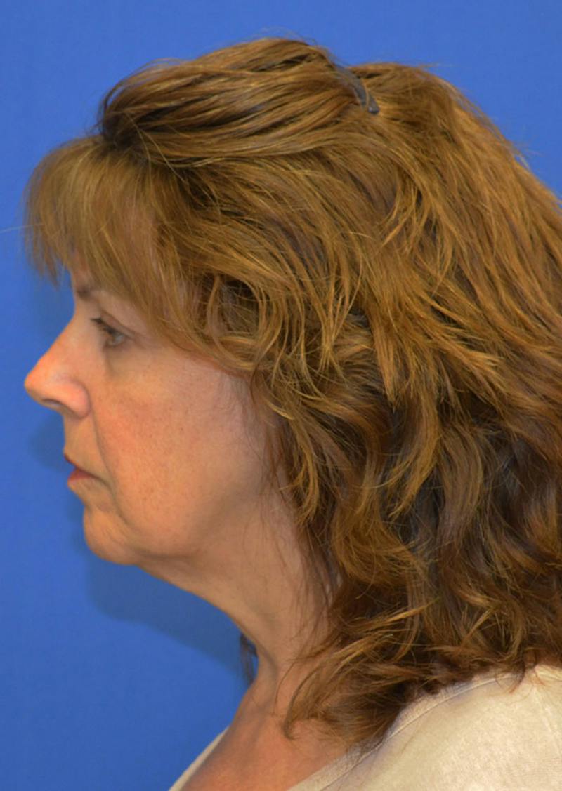 Facelift Before & After Gallery - Patient 149267 - Image 5