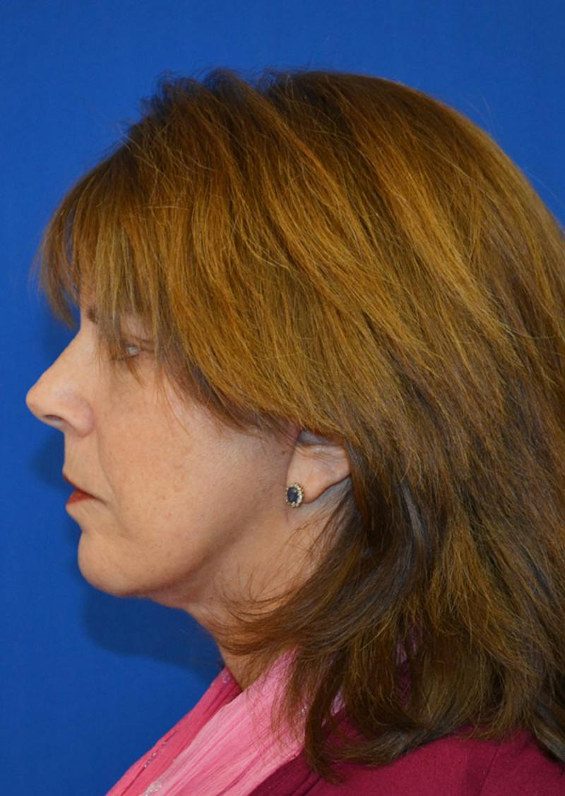 Facelift Before & After Gallery - Patient 149267 - Image 6