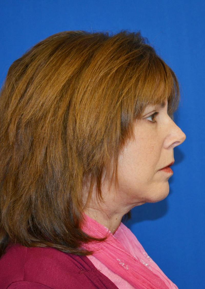 Facelift Before & After Gallery - Patient 149267 - Image 8