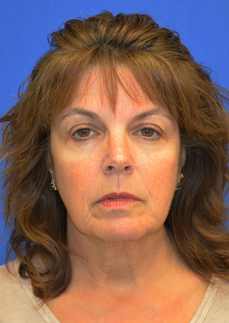 Facelift Before & After Gallery - Patient 149267 - Image 9