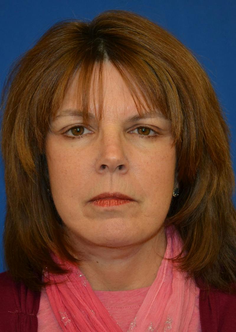 Facelift Before & After Gallery - Patient 149267 - Image 10