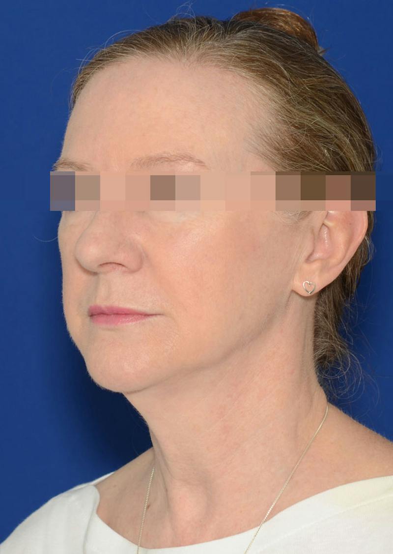 Facelift Before & After Gallery - Patient 778587 - Image 1