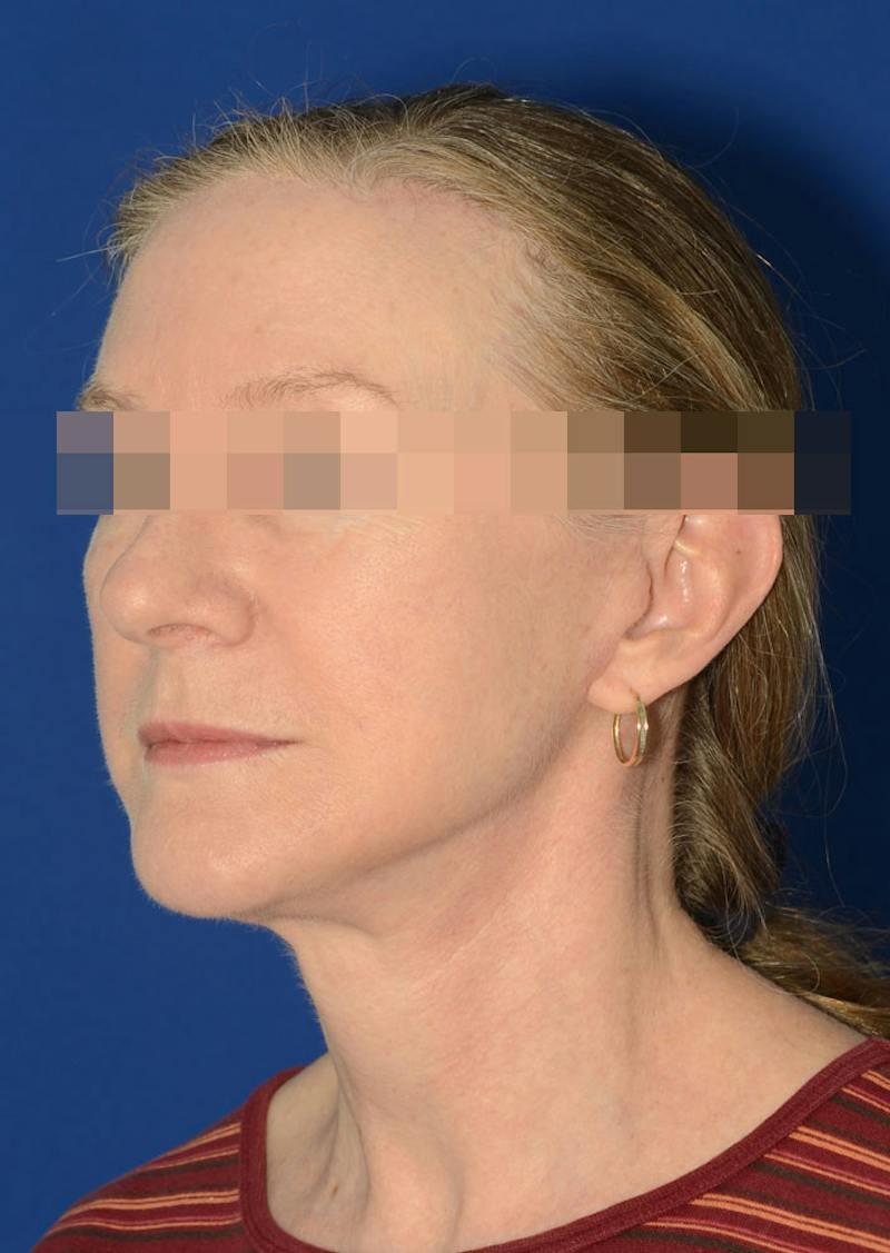Facelift Before & After Gallery - Patient 778587 - Image 2
