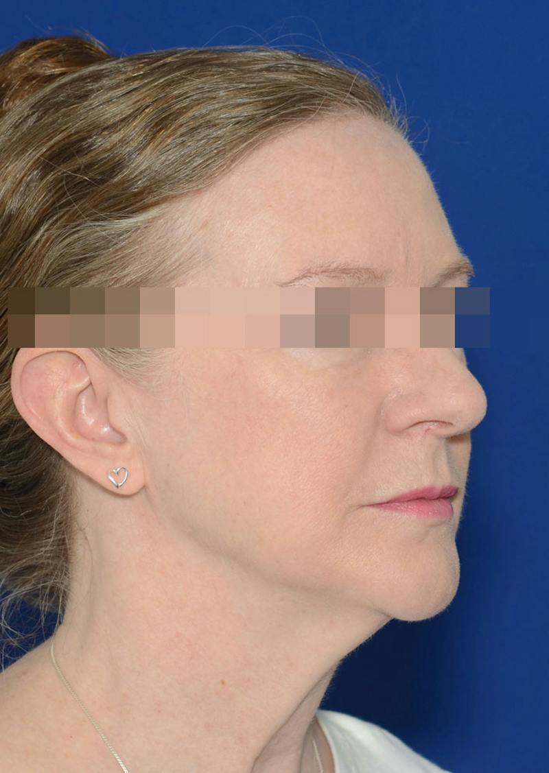 Facelift Before & After Gallery - Patient 778587 - Image 3