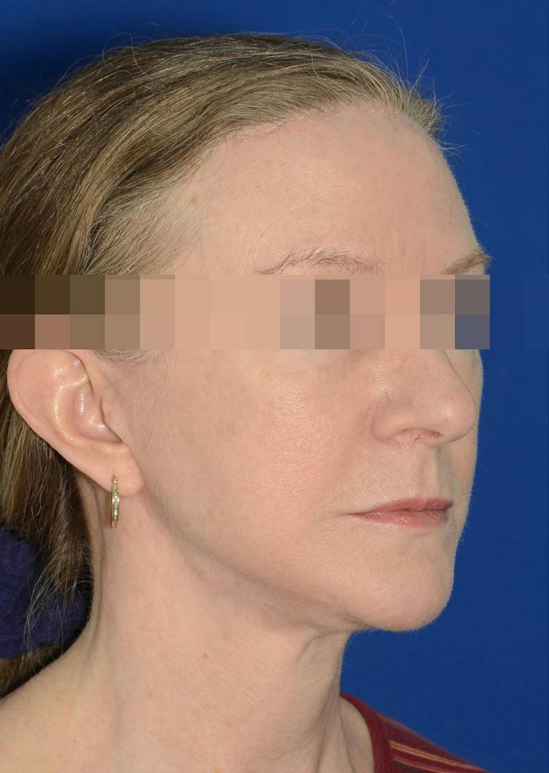Facelift Before & After Gallery - Patient 778587 - Image 4