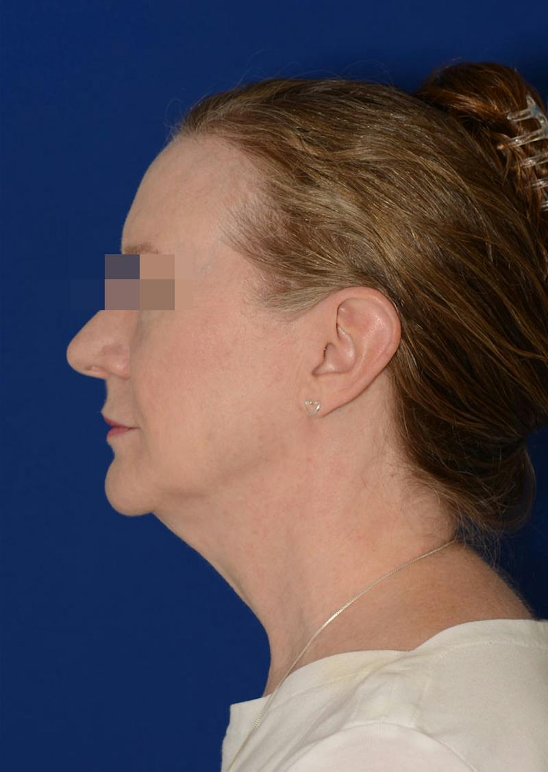 Facelift Before & After Gallery - Patient 778587 - Image 5