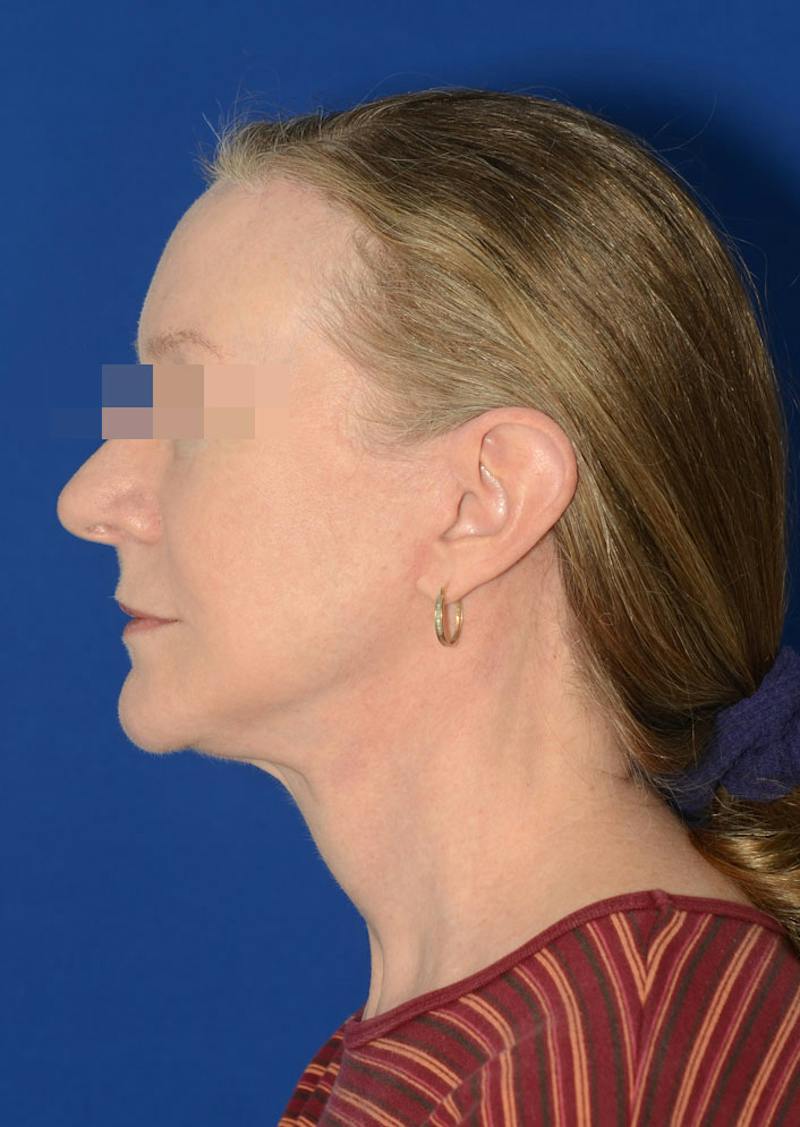 Facelift Before & After Gallery - Patient 778587 - Image 6