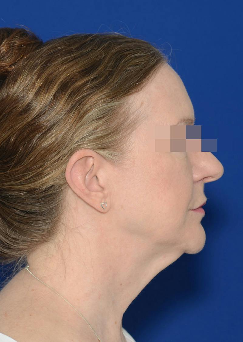 Facelift Before & After Gallery - Patient 778587 - Image 7