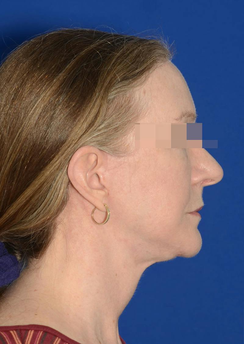 Facelift Before & After Gallery - Patient 778587 - Image 8