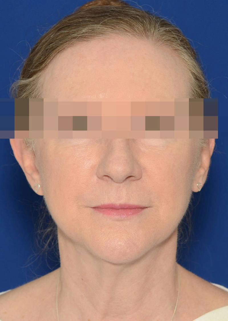 Facelift Before & After Gallery - Patient 778587 - Image 9