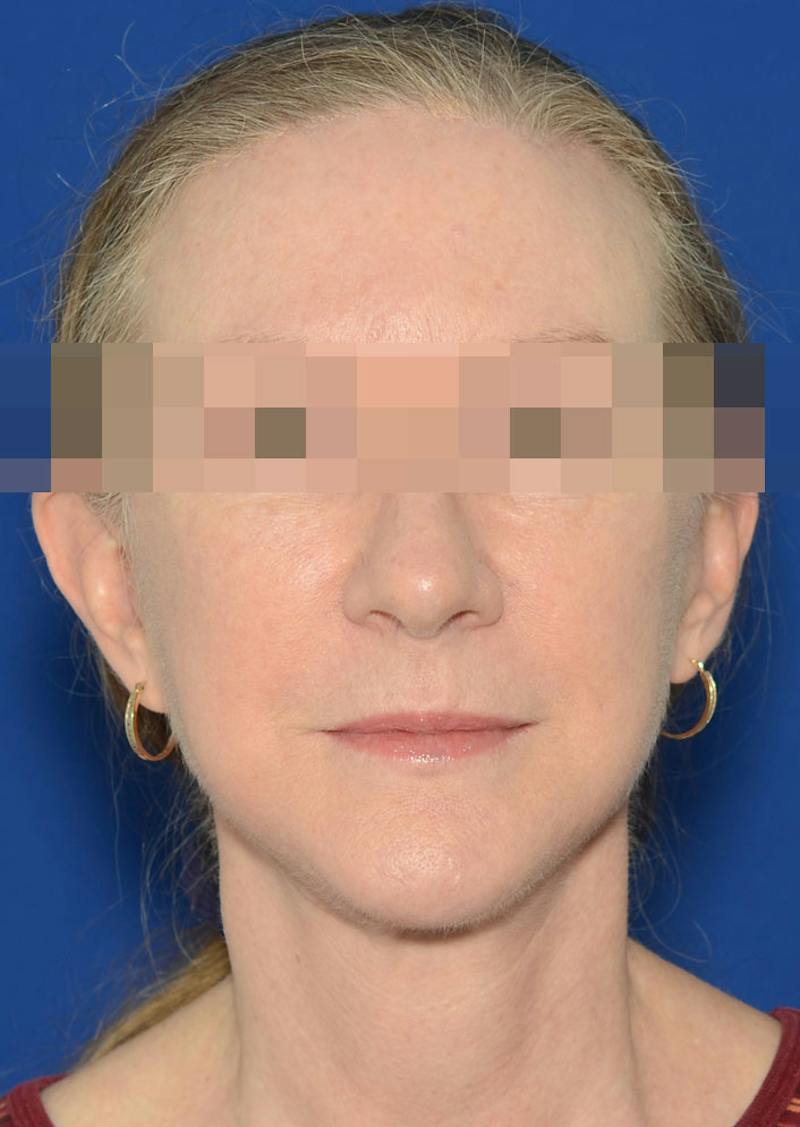 Facelift Before & After Gallery - Patient 778587 - Image 10
